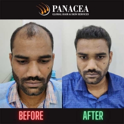 Hair Transplant Before After Result in Delhi